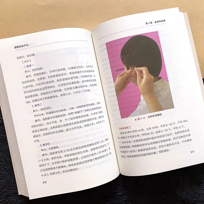 图解刺血疗法